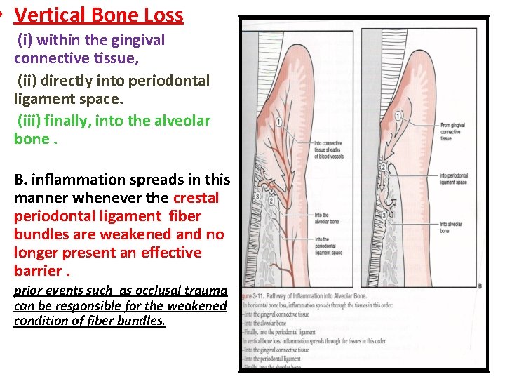  • Vertical Bone Loss • (i) within the gingival connective tissue, • (ii)