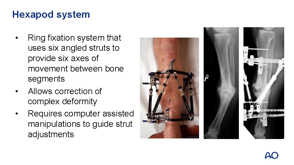 Hexapod system • • • Ring fixation system that uses six angled struts to