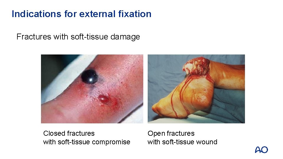 Indications for external fixation Fractures with soft-tissue damage Closed fractures with soft-tissue compromise Open