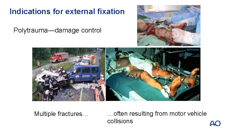 Indications for external fixation Polytrauma—damage control Multiple fractures… …often resulting from motor vehicle collisions
