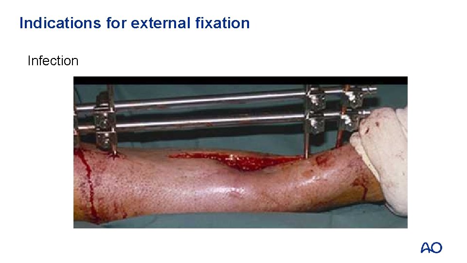 Indications for external fixation Infection 
