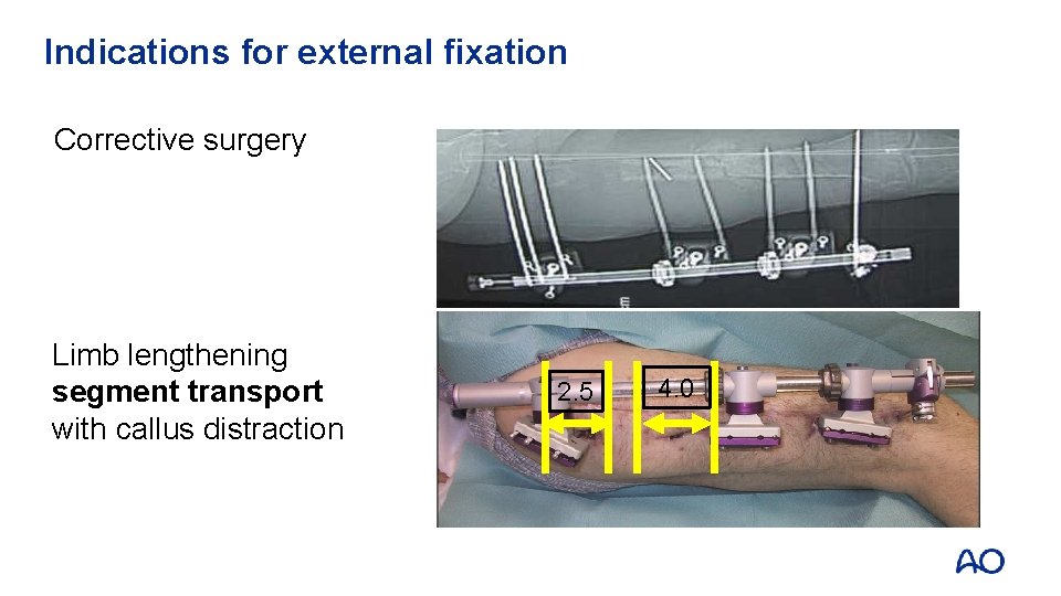 Indications for external fixation Corrective surgery Limb lengthening segment transport with callus distraction 2.