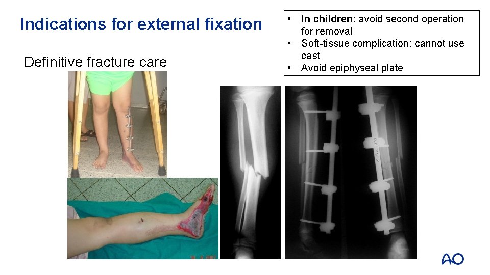 Principles of external fixation AO Trauma Basic Principles