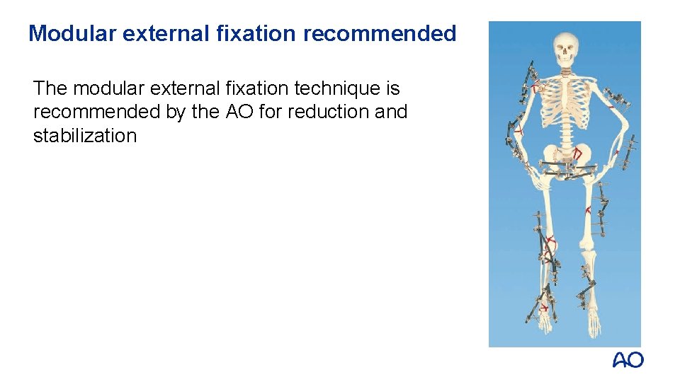 Modular external fixation recommended The modular external fixation technique is recommended by the AO