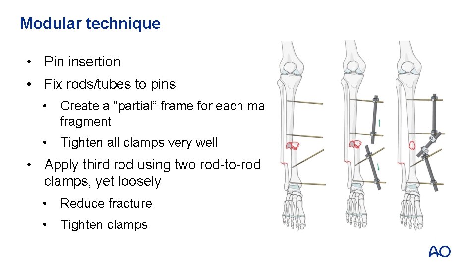 Modular technique • Pin insertion • Fix rods/tubes to pins • Create a “partial”