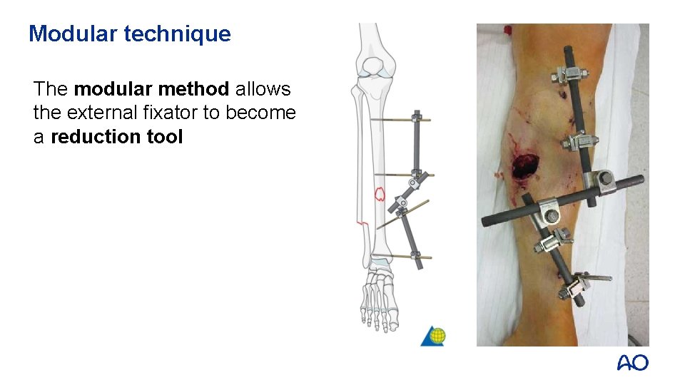 Modular technique The modular method allows the external fixator to become a reduction tool