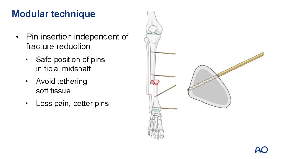 Modular technique • Pin insertion independent of fracture reduction • Safe position of pins