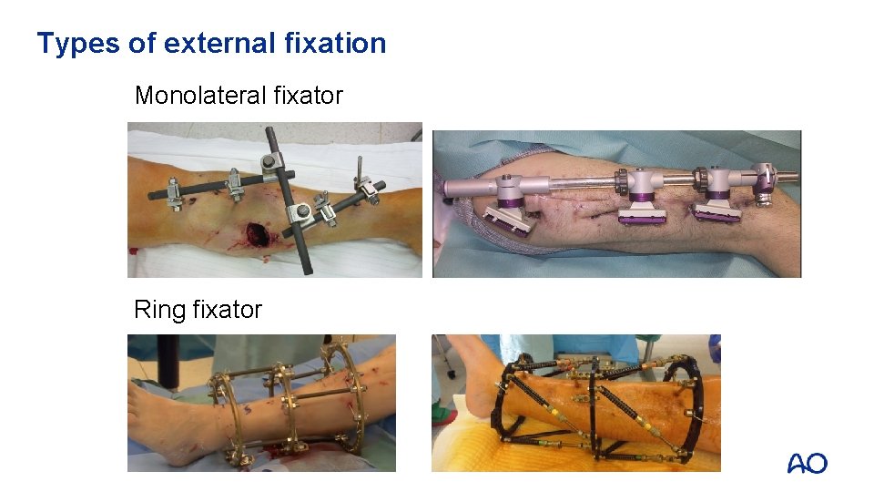 Types of external fixation Monolateral fixator Ring fixator 