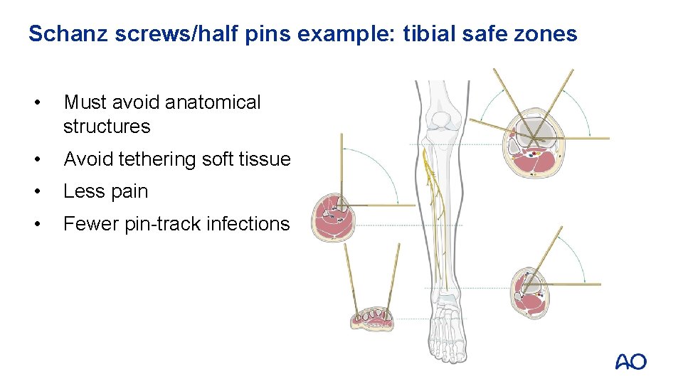 Schanz screws/half pins example: tibial safe zones • Must avoid anatomical structures • Avoid