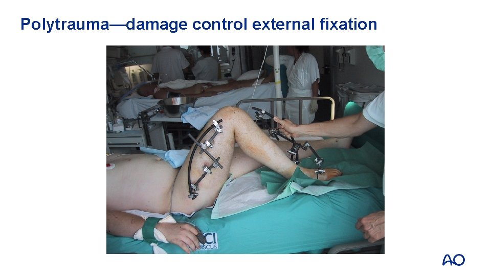 Polytrauma—damage control external fixation 