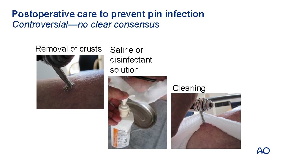 Postoperative care to prevent pin infection Controversial—no clear consensus Removal of crusts Saline or