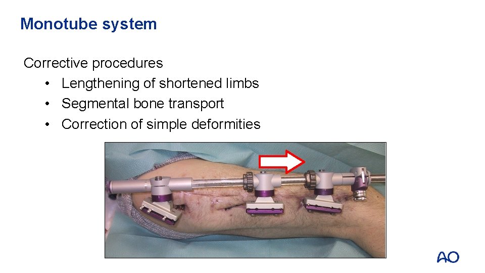 Monotube system Corrective procedures • Lengthening of shortened limbs • Segmental bone transport •
