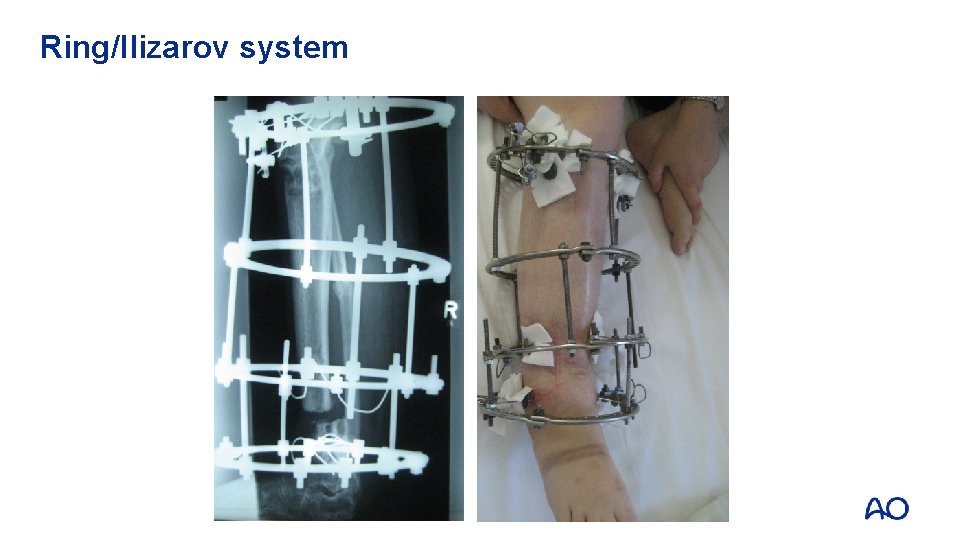 Ring/Ilizarov system 