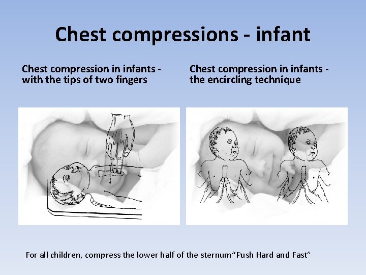 Chest compressions - infant Chest compression in infants with the tips of two fingers