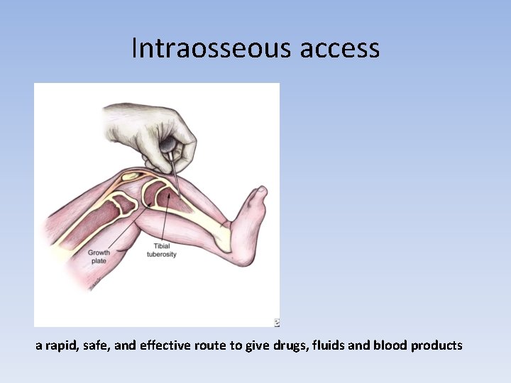 Intraosseous access a rapid, safe, and effective route to give drugs, fluids and blood