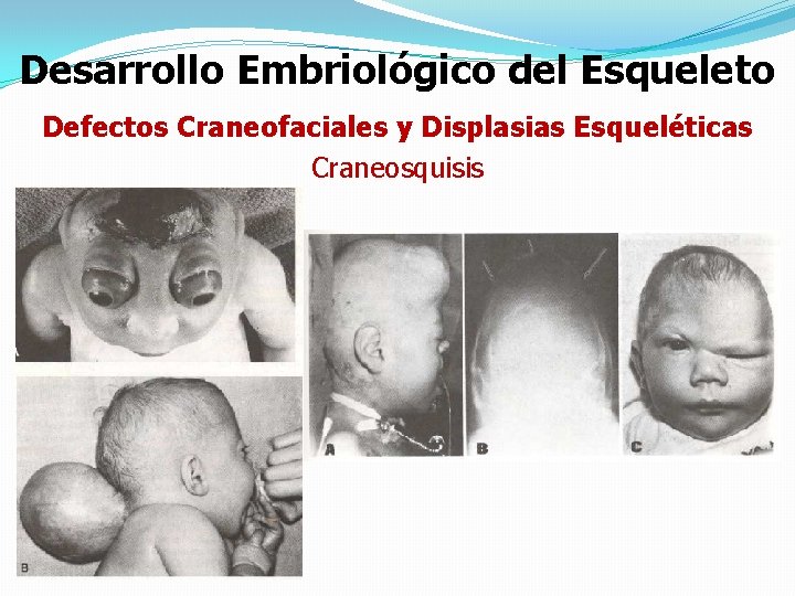 Desarrollo Embriológico del Esqueleto Defectos Craneofaciales y Displasias Esqueléticas Craneosquisis 