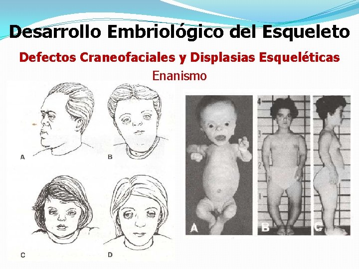 Desarrollo Embriológico del Esqueleto Defectos Craneofaciales y Displasias Esqueléticas Enanismo 