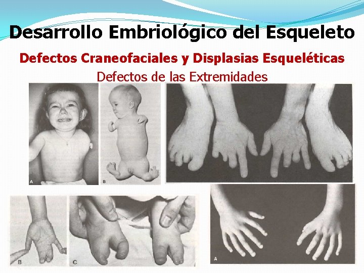 Desarrollo Embriológico del Esqueleto Defectos Craneofaciales y Displasias Esqueléticas Defectos de las Extremidades 
