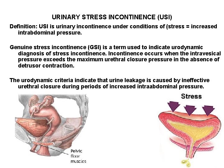 URINARY STRESS INCONTINENCE (USI) Definition: USI is urinary incontinence under conditions of (stress =