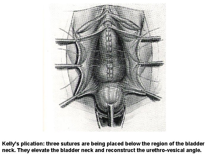 Kelly’s plication: three sutures are being placed below the region of the bladder neck.
