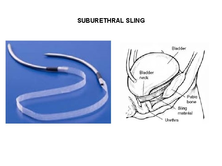 SUBURETHRAL SLING 