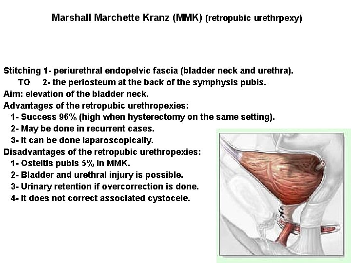 Marshall Marchette Kranz (MMK) (retropubic urethrpexy) Stitching 1 - periurethral endopelvic fascia (bladder neck