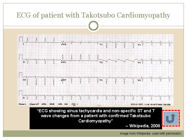 ECG of patient with Takotsubo Cardiomyopathy “ECG showing sinus tachycardia and non-specific ST and