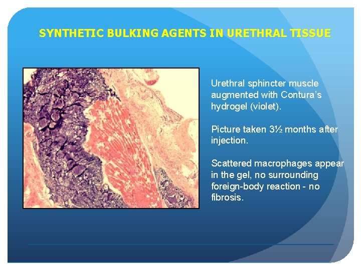 SYNTHETIC BULKING AGENTS IN URETHRAL TISSUE Urethral sphincter muscle augmented with Contura’s hydrogel (violet).