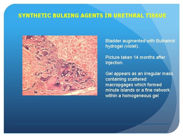 SYNTHETIC BULKING AGENTS IN URETHRAL TISSUE Bladder augmented with Bulkamid hydrogel (violet). Picture taken