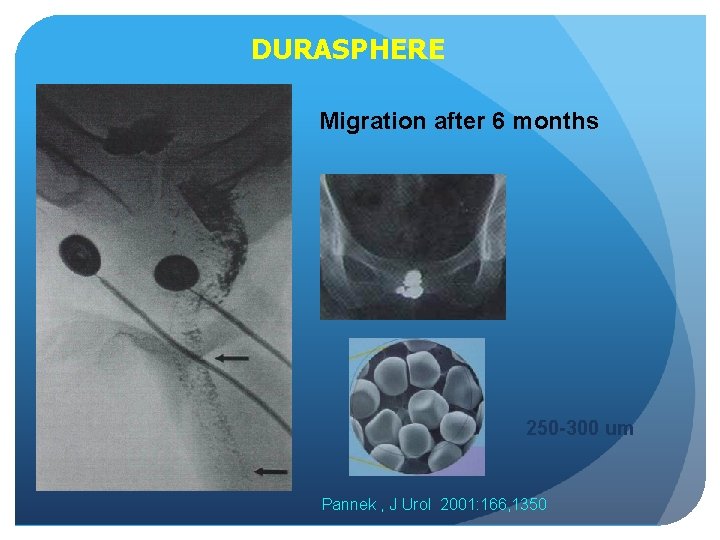 DURASPHERE Migration after 6 months 250 -300 um Pannek , J Urol 2001: 166,