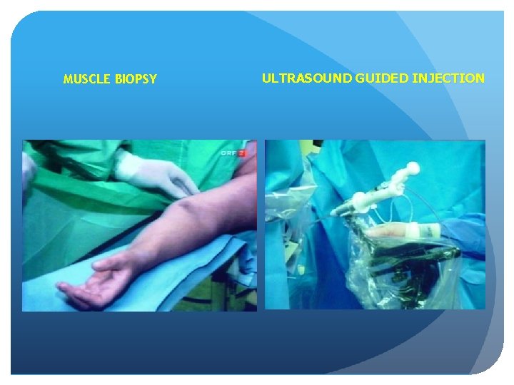 MUSCLE BIOPSY ULTRASOUND GUIDED INJECTION 