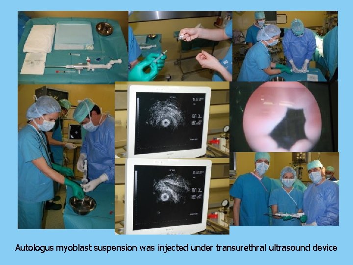 Autologus myoblast suspension was injected under transurethral ultrasound device 