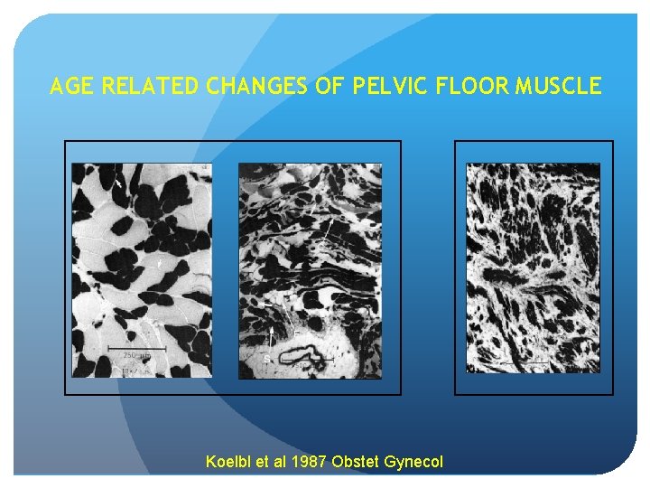 AGE RELATED CHANGES OF PELVIC FLOOR MUSCLE Koelbl et al 1987 Obstet Gynecol 