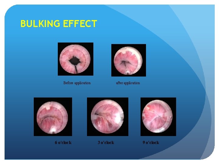 BULKING EFFECT Before application 6 o’clock after application 3 o’clock 9 o’clock 