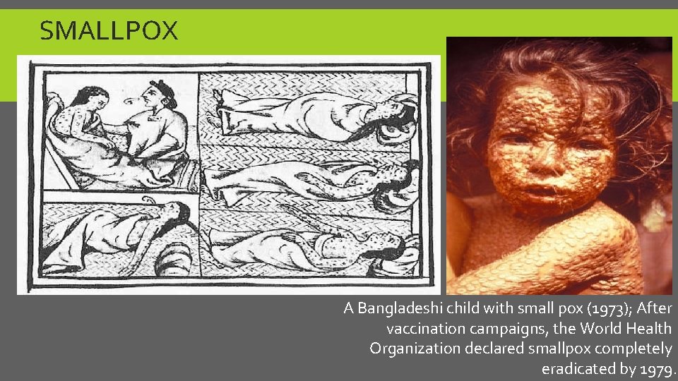 SMALLPOX A Bangladeshi child with small pox (1973); After vaccination campaigns, the World Health