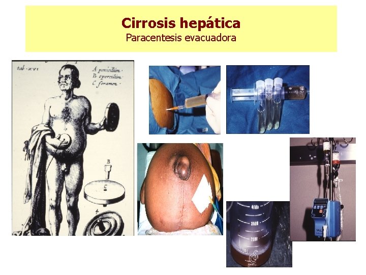Cirrosis hepática Paracentesis evacuadora 