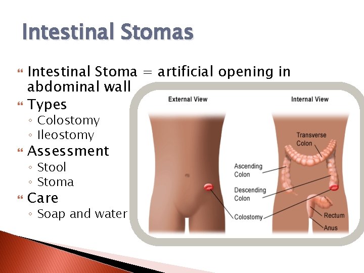Intestinal Stomas Intestinal Stoma = artificial opening in abdominal wall Types Assessment Care ◦