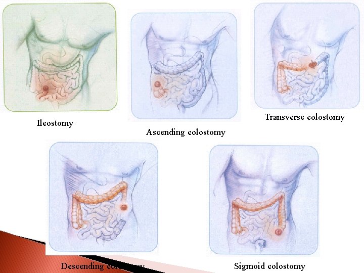  Stoma picture Ileostomy Descending colostomy Transverse colostomy Ascending colostomy Sigmoid colostomy 