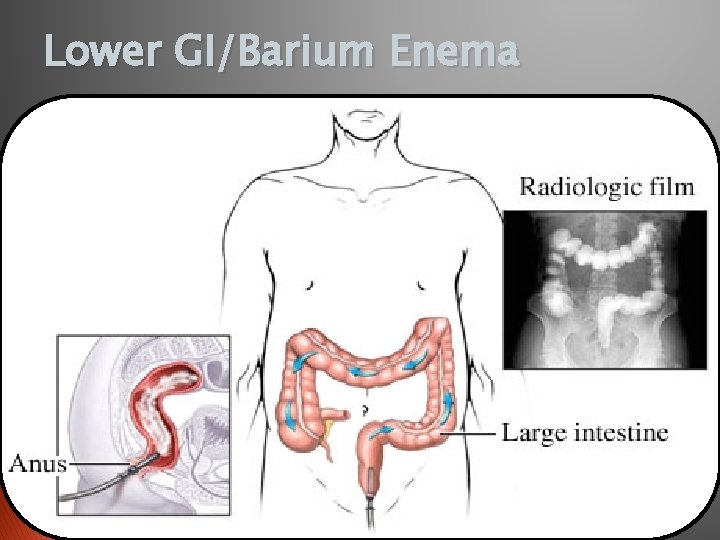 Lower GI/Barium Enema 