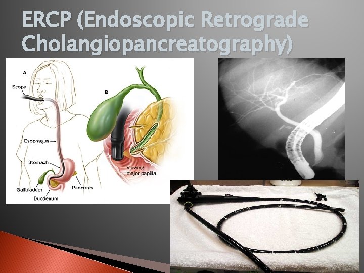 ERCP (Endoscopic Retrograde Cholangiopancreatography) 