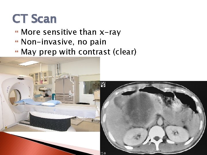 CT Scan More sensitive than x-ray Non-invasive, no pain May prep with contrast (clear)