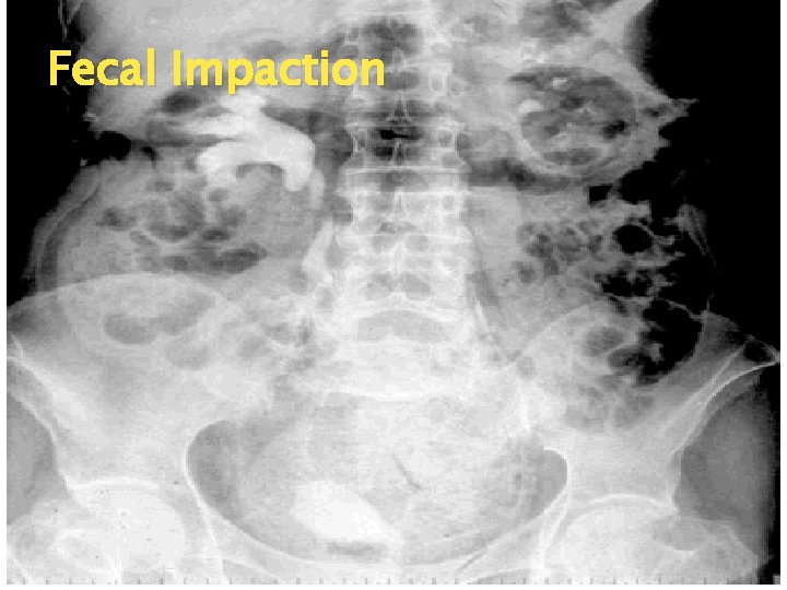 Fecal Impaction 