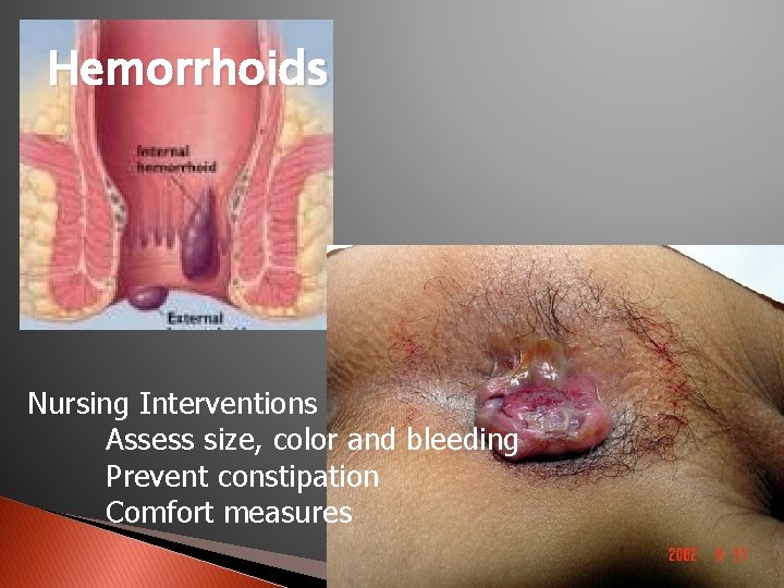 Hemorrhoids Nursing Interventions Assess size, color and bleeding Prevent constipation Comfort measures 