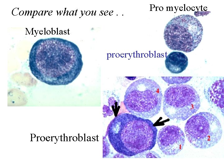 Compare what you see. . . Myeloblast Pro myelocyte proerythroblast Proerythroblast 