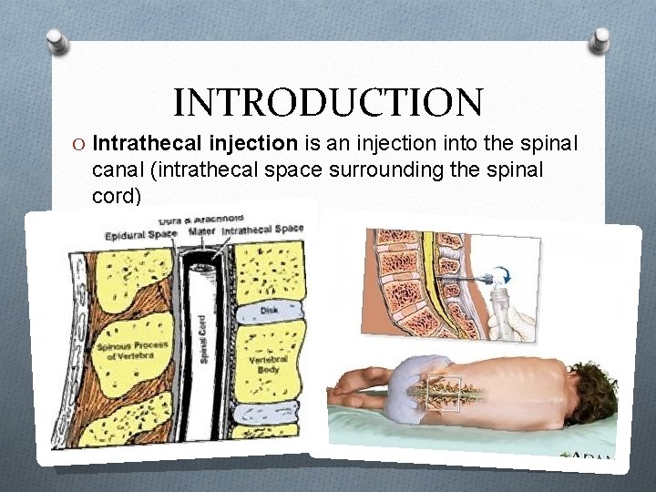 INTRODUCTION O Intrathecal injection is an injection into the spinal canal (intrathecal space surrounding