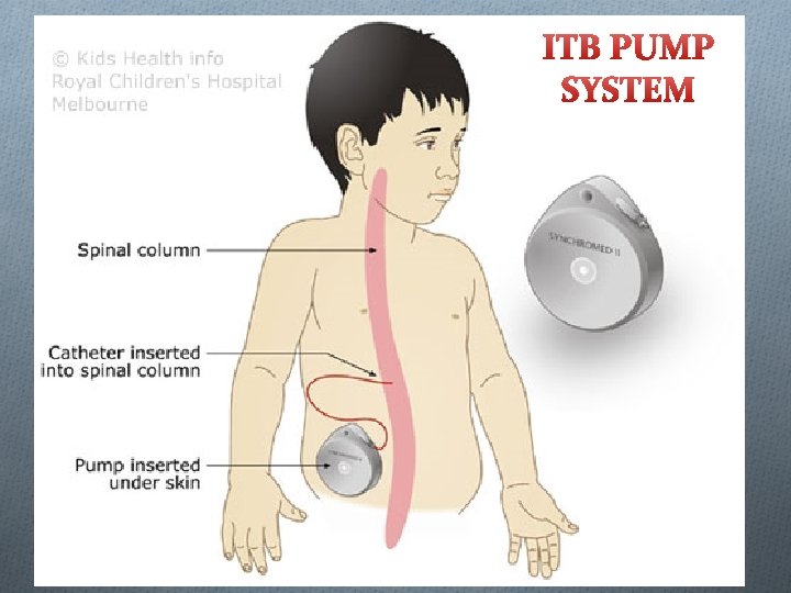 ITB PUMP SYSTEM 