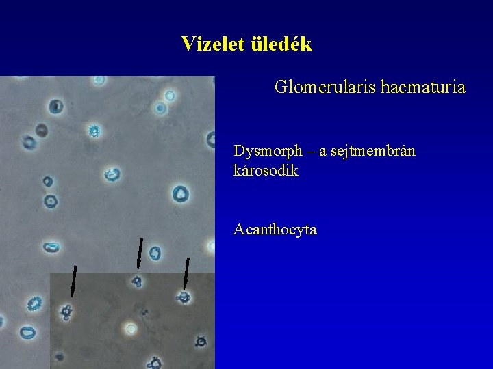 Vizelet üledék Glomerularis haematuria Dysmorph – a sejtmembrán károsodik Acanthocyta 