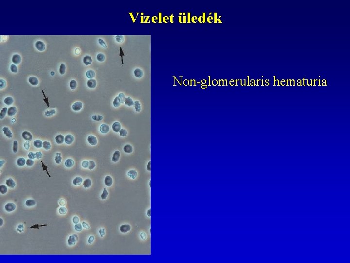 Vizelet üledék Non-glomerularis hematuria 