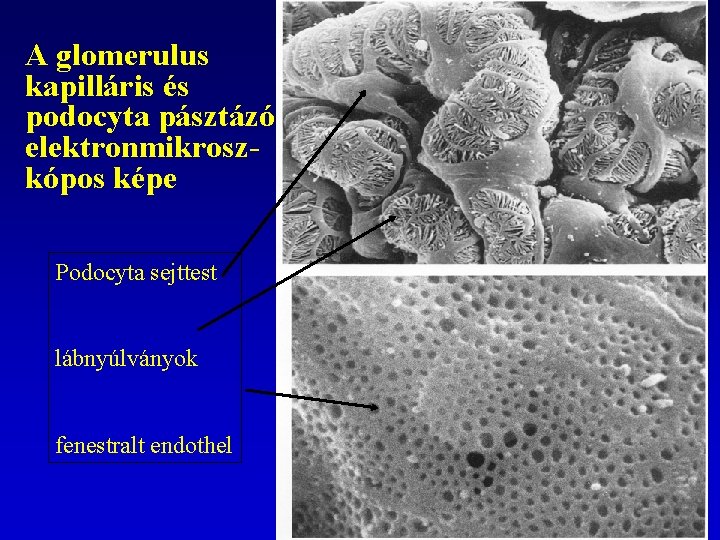 A glomerulus kapilláris és podocyta pásztázó elektronmikroszkópos képe Podocyta sejttest lábnyúlványok fenestralt endothel 