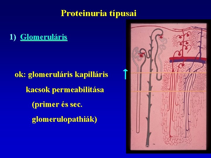 Proteinuria típusai 1) Glomeruláris ok: glomeruláris kapilláris kacsok permeabilitása (primer és sec. glomerulopathiák) 